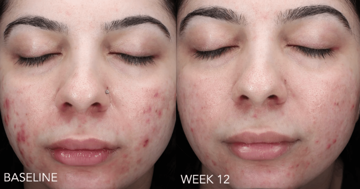 Retinol + Blemish Complex NEU