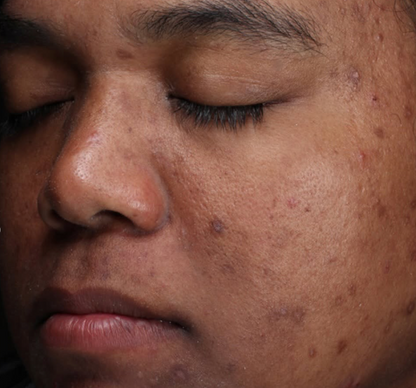 Retinol + Blemish Complex NEU