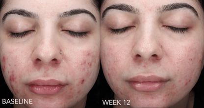 Retinol + Blemish Complex NEU